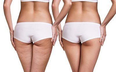 No.1 Best Cellulite Reduction-Rockwall Complete Wellness Spa